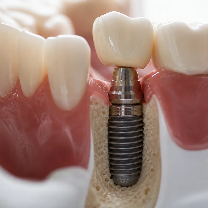 Dental Implants clinical detail