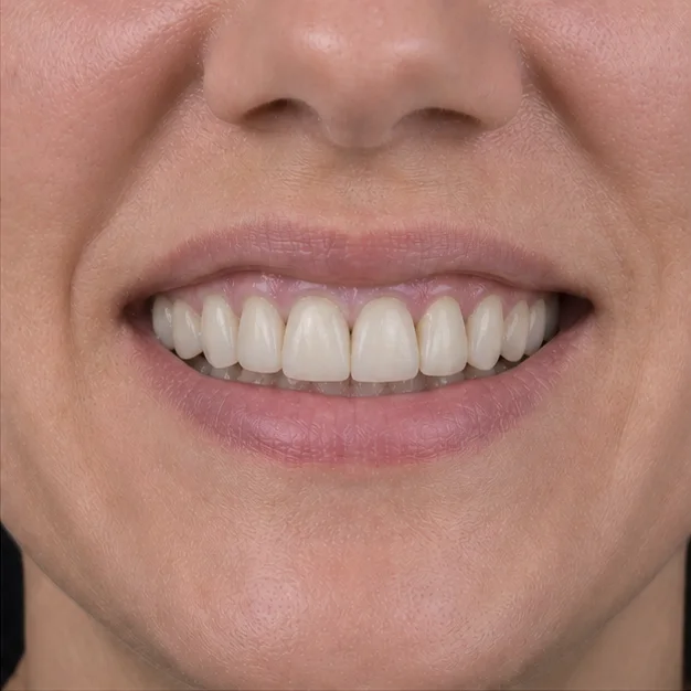 Old crowns, renewed naturally illustrative after result