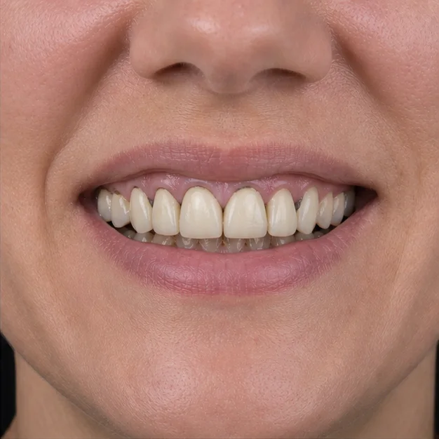 Old crowns, renewed naturally before treatment planning